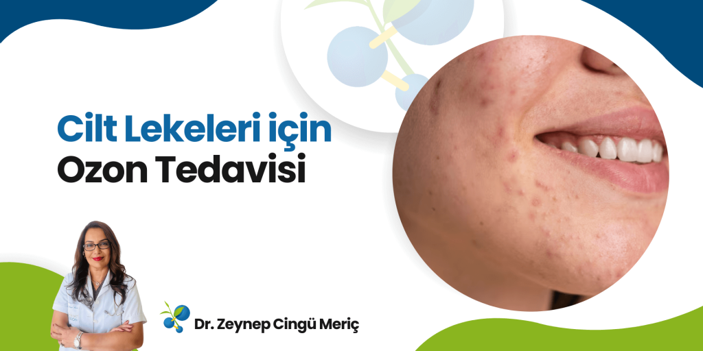 Cilt Lekeleri ve Ozon Tedavisi: Etkili Bir Çözüm